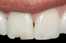 Клиновидный эффект зубов