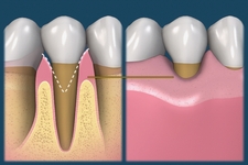 некариозные поражения зубов