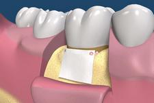 костная регенерация зубов