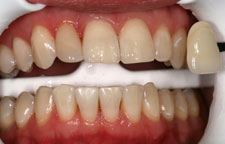 зубы после отбеливания