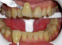 зубы до отбеливания